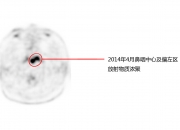 1988彩票最新网-同仁医院眼科Smile全飞秒技术正式启动