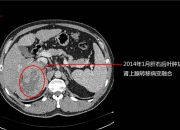 澳门角子机最大多少倍-被国家医保局公开问询，心脉医疗将Castor支架降价40%左右