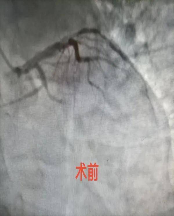 2024激光近视眼手术价格，含全激光/半飞秒/全飞秒激光手术费用