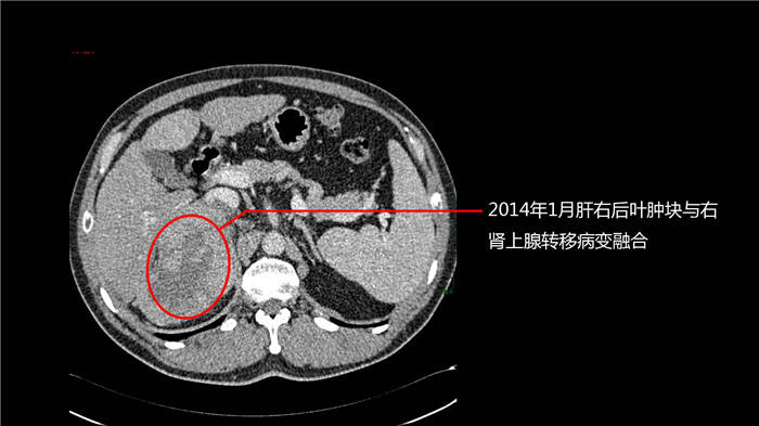 澳门角子机最大多少倍-被国家医保局公开问询，心脉医疗将Castor支架降价40%左右