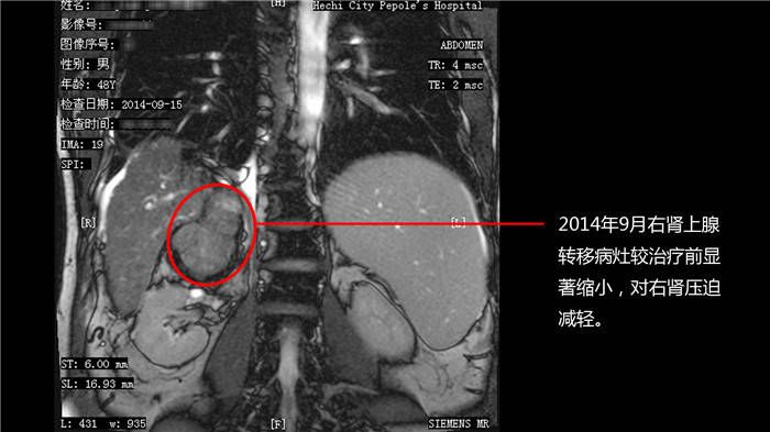 孕妇乘飞机意外早产 医护万米高空协力救